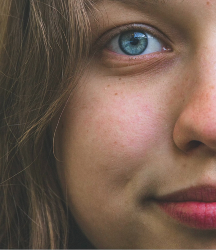  Nourished, Perioral dermatitis, dermatitis, eczema, eczeem, sensitive skin, gevoelige huid. 