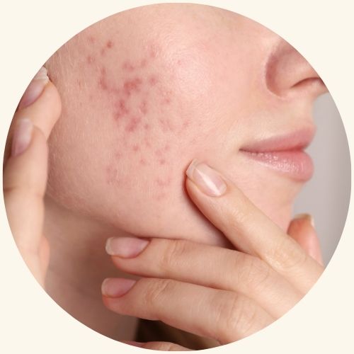 skincare for acne skin | Nourished