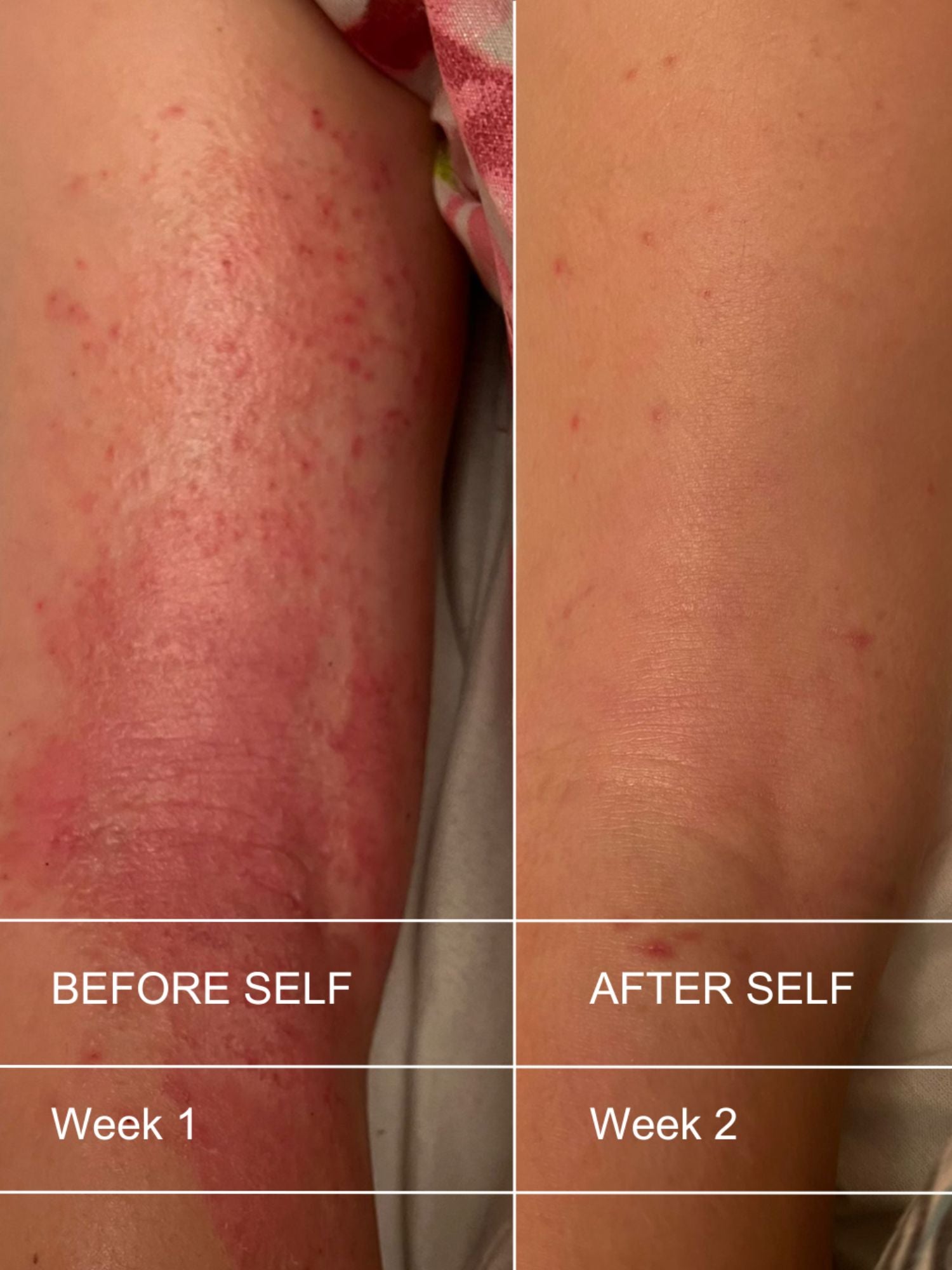 Deep Nourishing Body Butter, before & after eczema, Natural Self, Self Skincare, Nourished