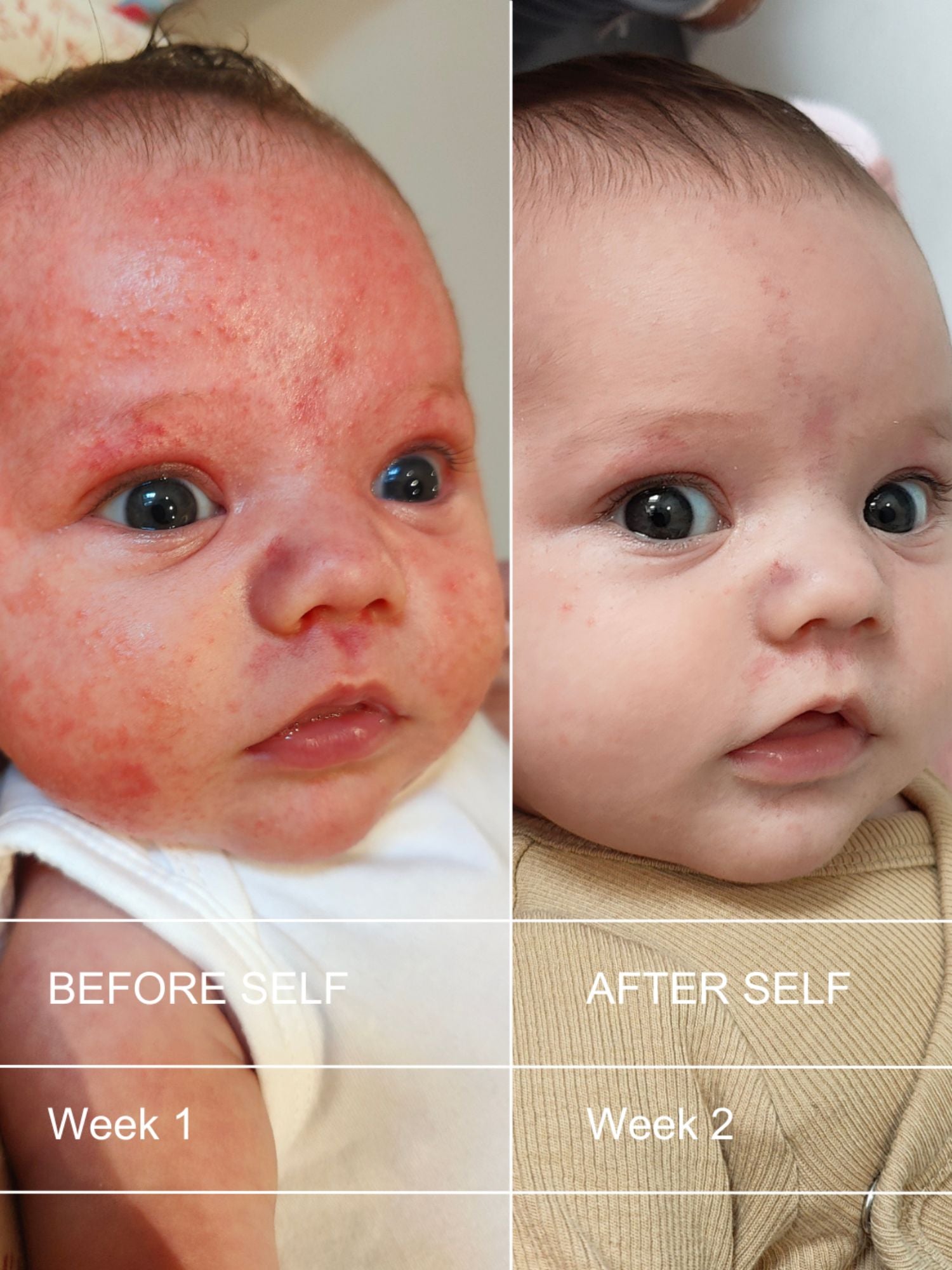 Deep Nourishing Body Butter, before & after eczema, Natural Self, Self Skincare, Nourished